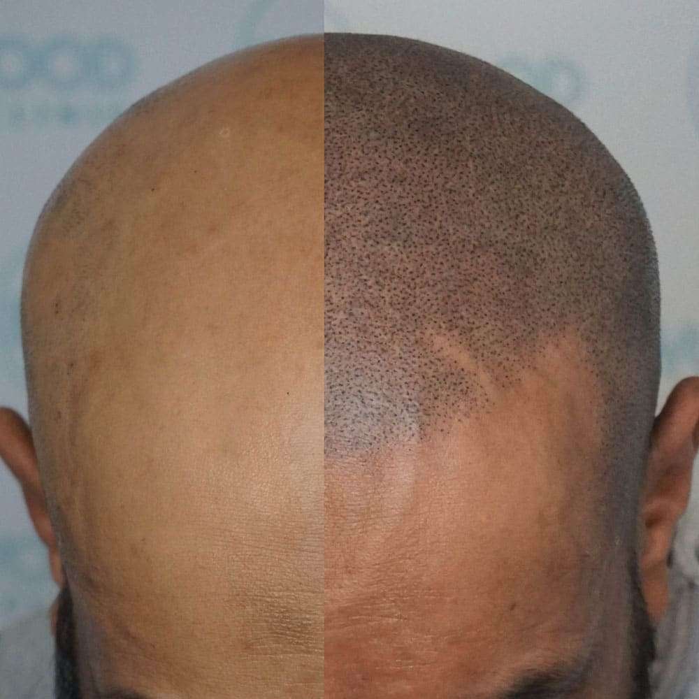 Things You Should About Scalp Micropigmentation
