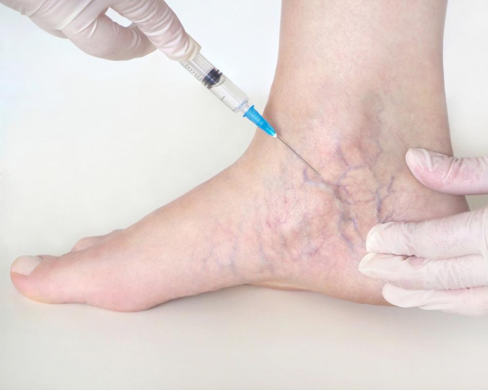 Varicose vein treatments in San Antonio
